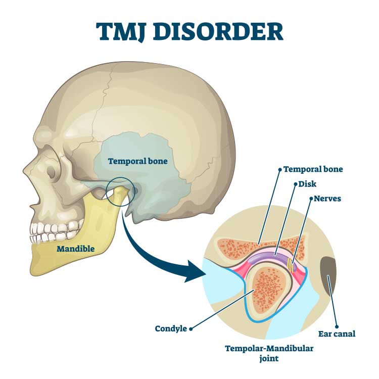 can-headphones-cause-tmj-disorders